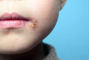 Why Treating Herpes is Essential