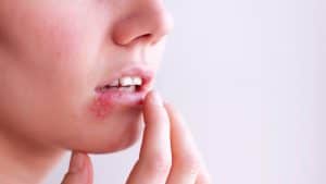 Treating Herpes Naturally: Minimizing Side Effects