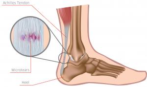 Spotting Achilles Tendinitis: Here are the Warning Signs