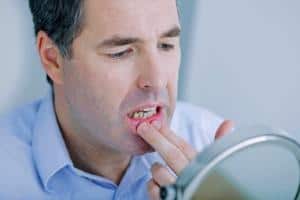 Understanding And Naturally Treating Mouth Ulcers: A Guide